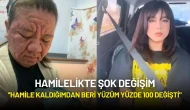 Hamilelikte Şok Değişim: ''Hamile Kaldığımdan Beri Yüzüm Yüzde 100 Değişti"