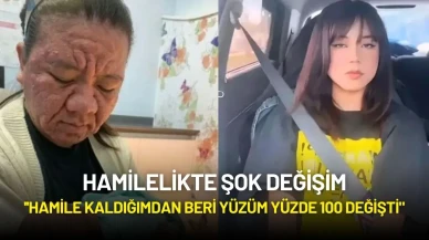 Hamilelikte Şok Değişim: ''Hamile Kaldığımdan Beri Yüzüm Yüzde 100 Değişti"