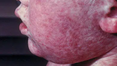 Aşı Karşıtları Tehlike Oluşturuyor! Texas'ta Kızamık Salgını Hızla Yayılıyor