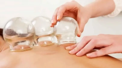 Hacamat Nedir? 2025 Altın Hacamat Günleri ve Faydaları Nelerdir?