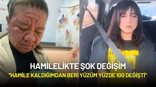 Hamilelikte Şok Değişim: ''Hamile Kaldığımdan Beri Yüzüm Yüzde 100 Değişti"