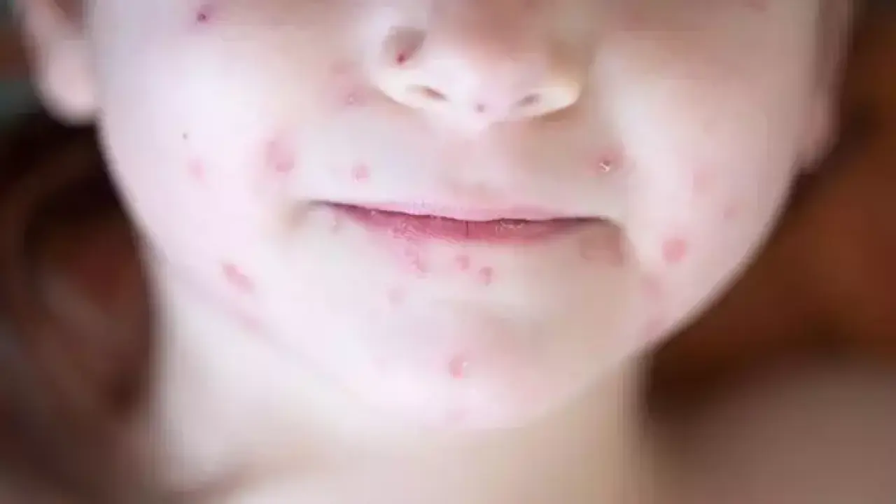 Aşı Karşıtları Tehlike Oluşturuyor! Texas'ta Kızamık Salgını Hızla Yayılıyor 2